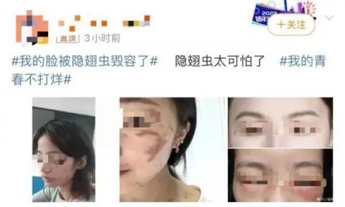 隐翅虫的毒液堪比硫酸!专家提醒: 见到千万别拍